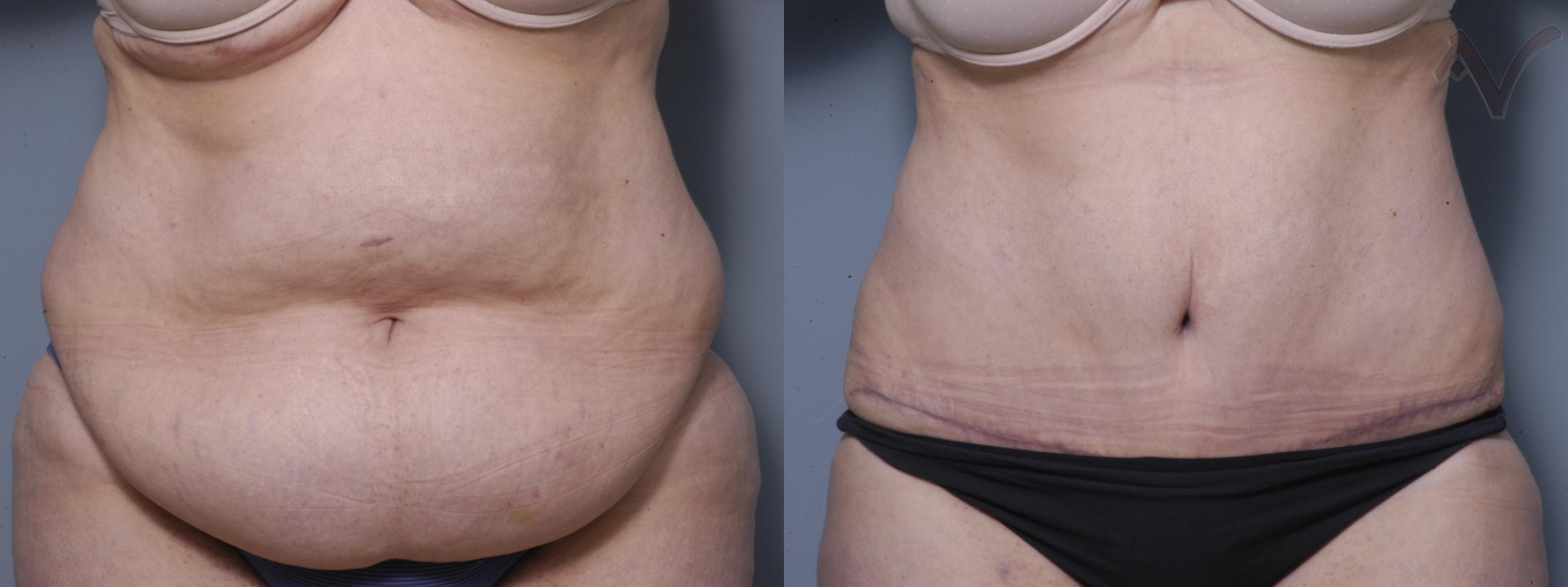 Before & After Tummy Tuck Case 240 Front View in Burbank, CA