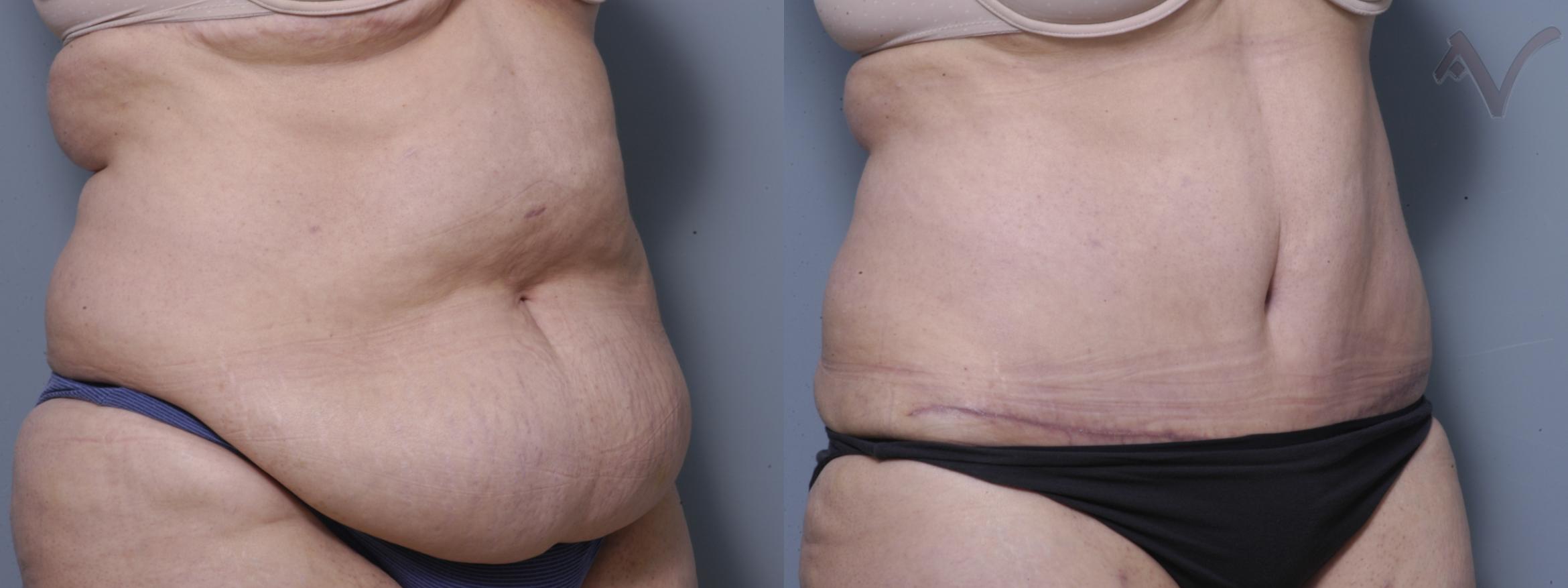 Before & After Tummy Tuck Case 240 Right Oblique View in Burbank, CA