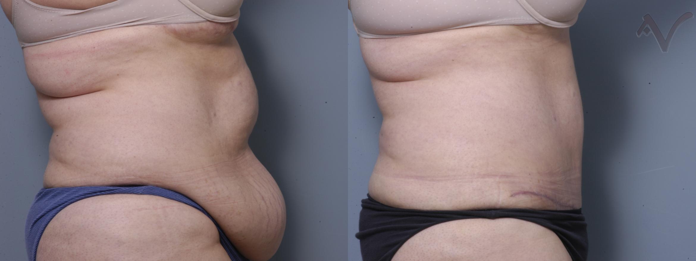 Before & After Tummy Tuck Case 240 Right Side View in Burbank, CA