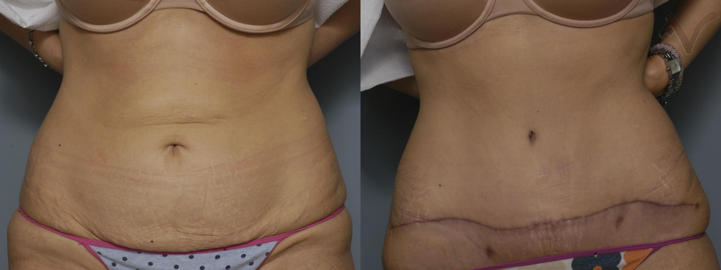 Before & After Tummy Tuck Case 245 Front View in Burbank, CA