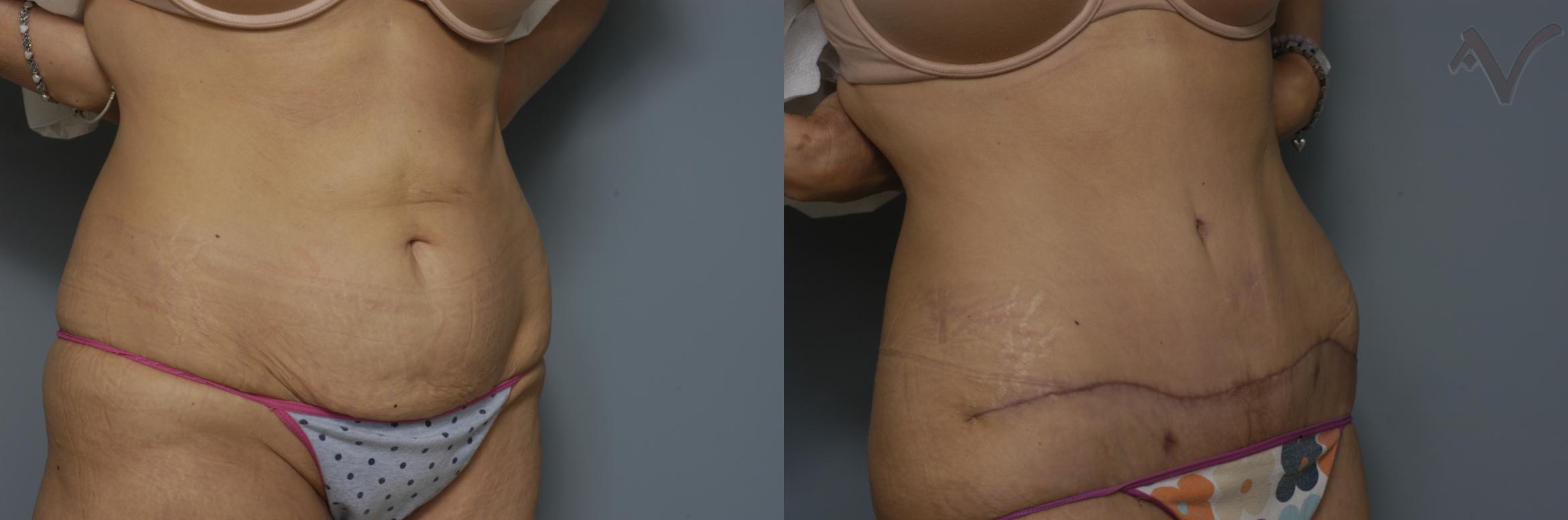 Before & After Tummy Tuck Case 245 Right Oblique View in Burbank, CA