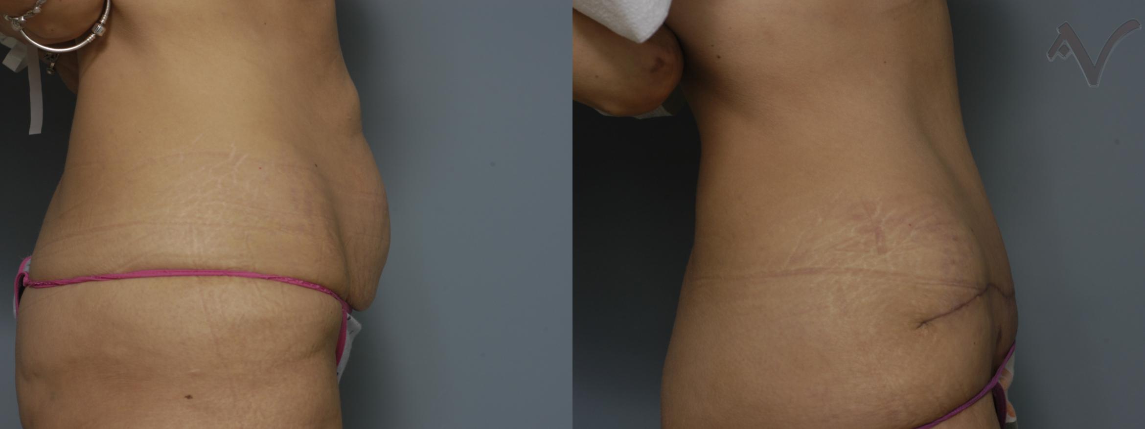 Before & After Tummy Tuck Case 245 Right Side View in Burbank, CA