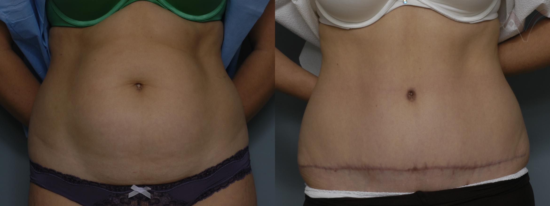 Before & After Tummy Tuck Case 247 Front View in Los Angeles, CA