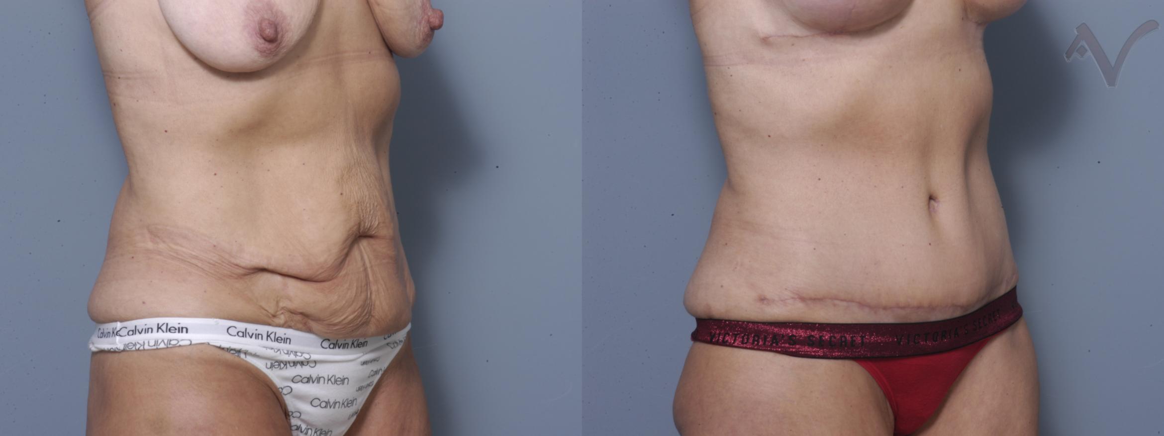 Before & After Tummy Tuck Case 249 Right Oblique View in Burbank, CA