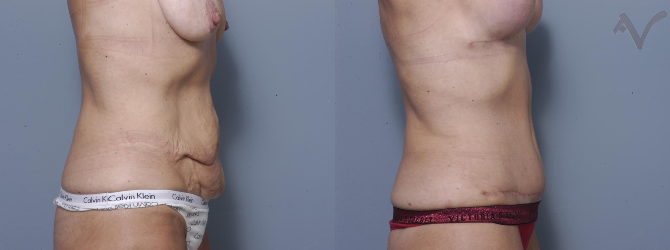Before & After Tummy Tuck Case 249 Right Side View in Burbank, CA