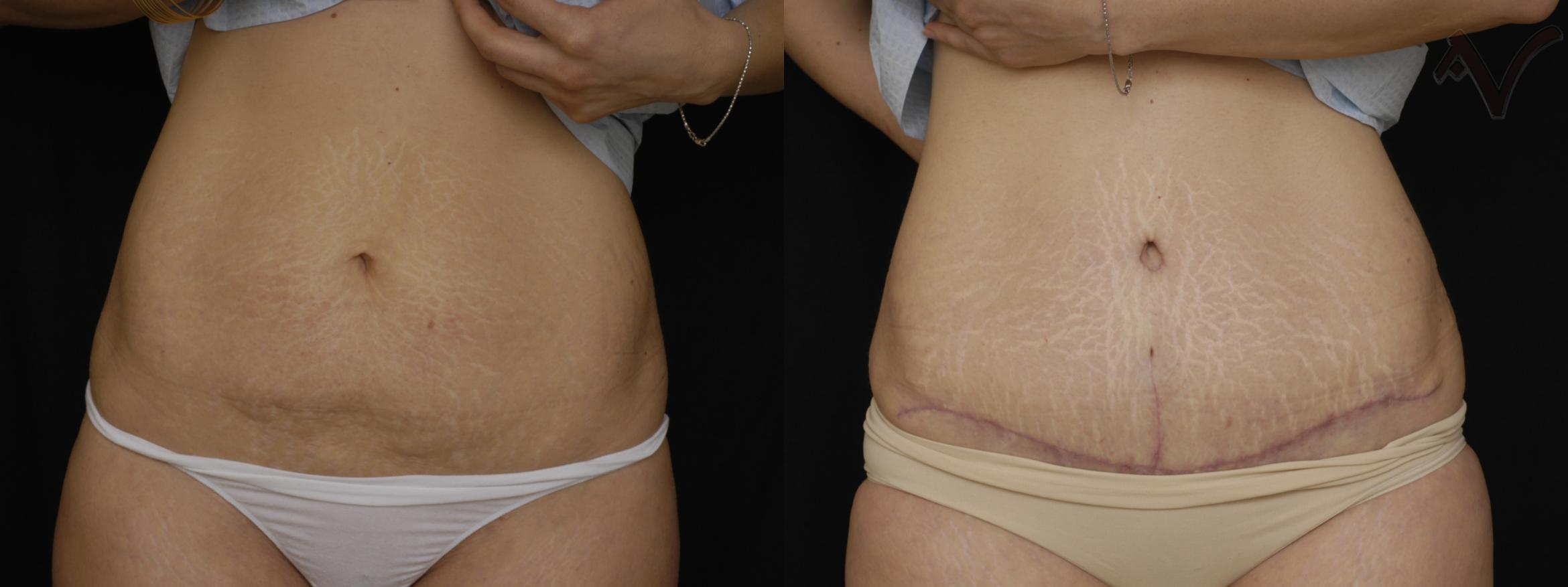 Before & After Tummy Tuck Case 250 Front View in Los Angeles, CA