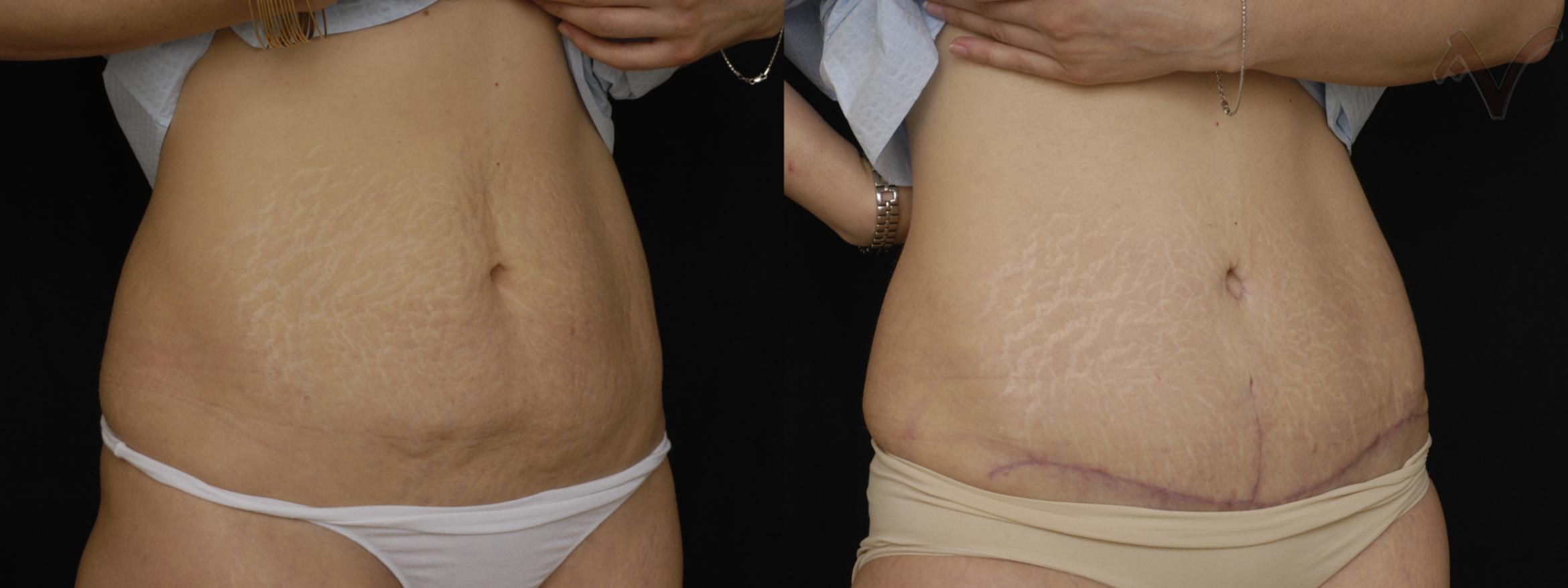 Before & After Tummy Tuck Case 250 Right Oblique View in Los Angeles, CA