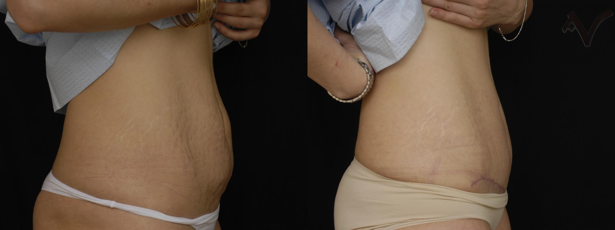 Before & After Tummy Tuck Case 250 Right Side View in Los Angeles, CA