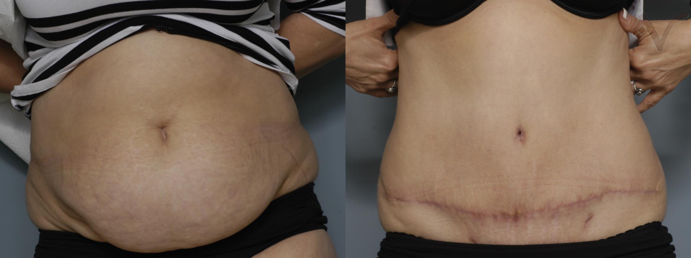 Before & After Tummy Tuck Case 267 Front View in Los Angeles, CA