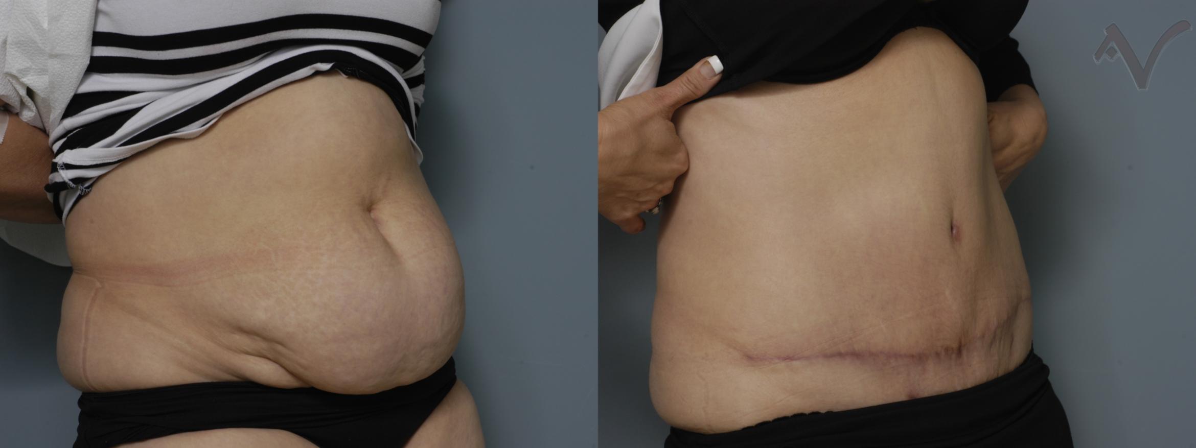 Before & After Tummy Tuck Case 267 Right Oblique View in Burbank, CA