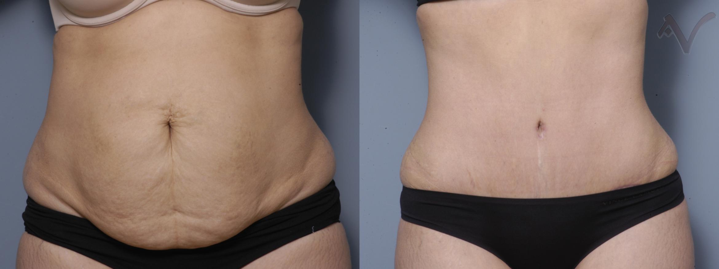 Before & After Tummy Tuck Case 271 Front View in Los Angeles, CA