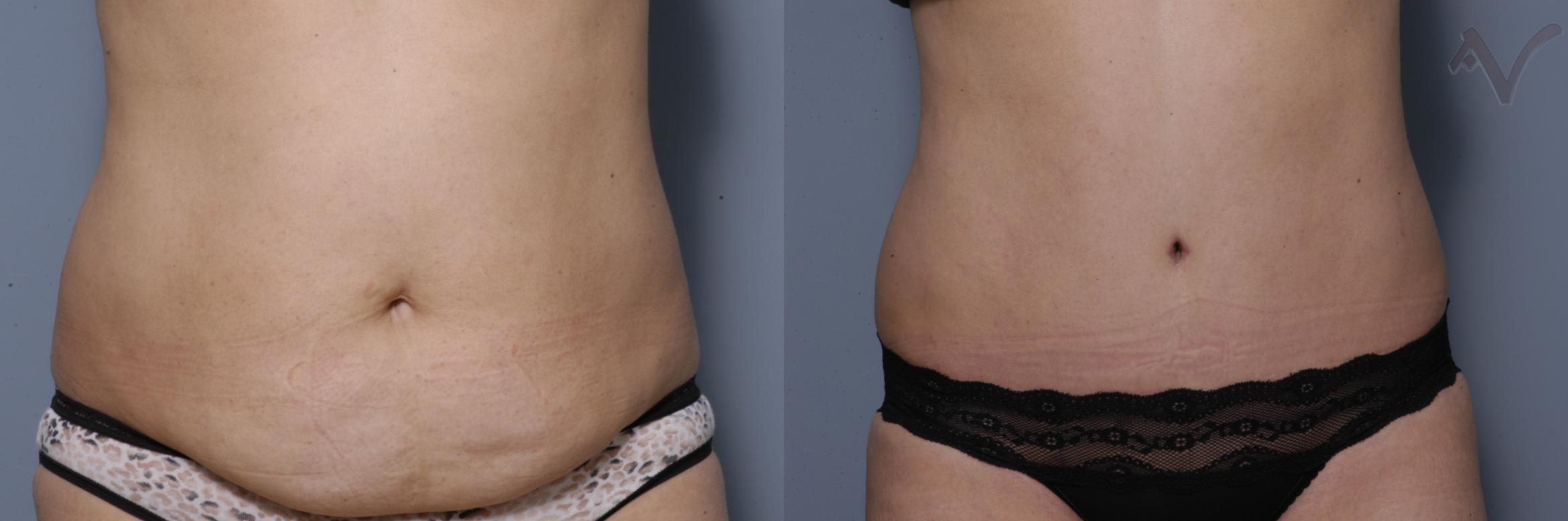 Before & After Tummy Tuck Case 284 Front View in Los Angeles, CA