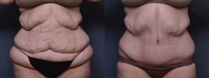 Before & After Abdominoplasty after Massive Weight Loss Case 388 Front View in Los Angeles, CA