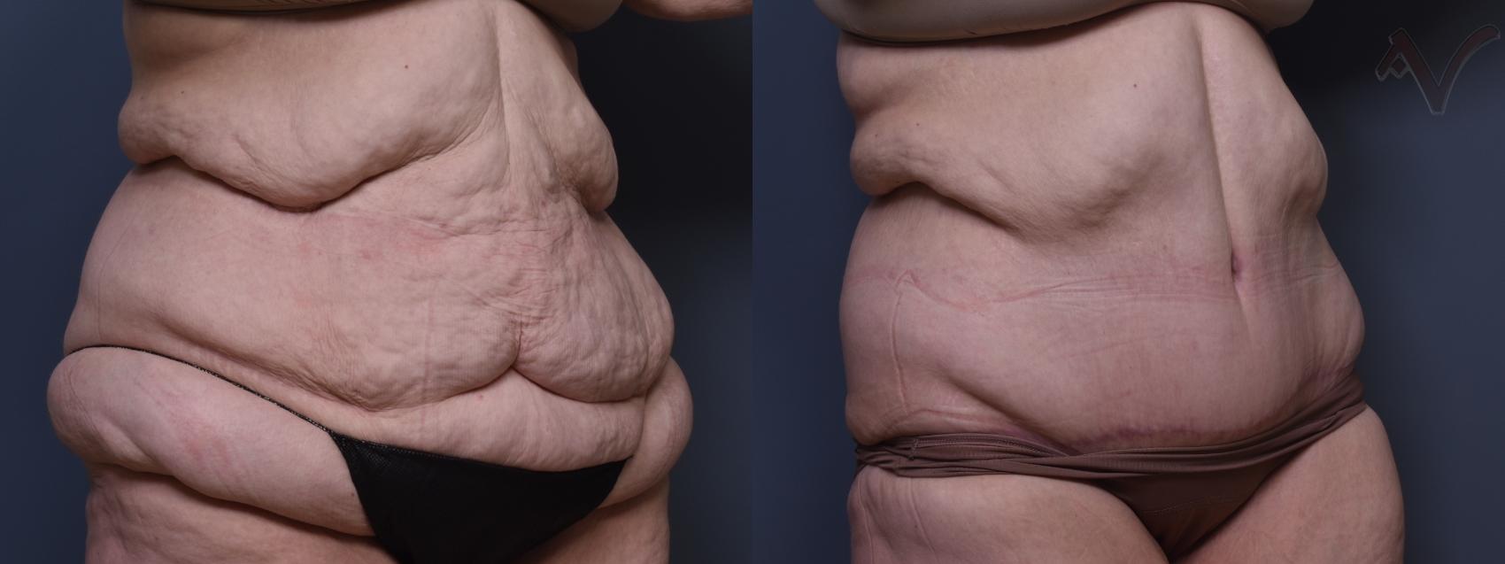 Before & After Abdominoplasty after Massive Weight Loss Case 388 Right Oblique View in Los Angeles, CA