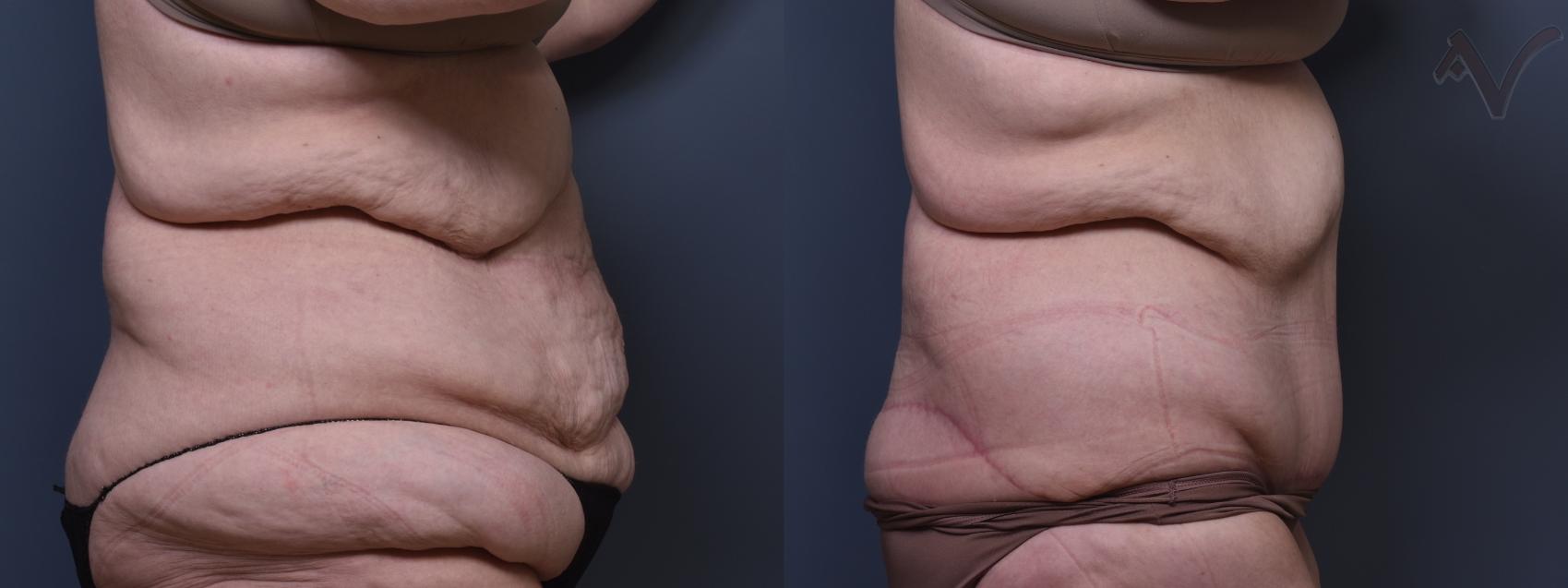 Before & After Abdominoplasty after Massive Weight Loss Case 388 Right Side View in Los Angeles, CA