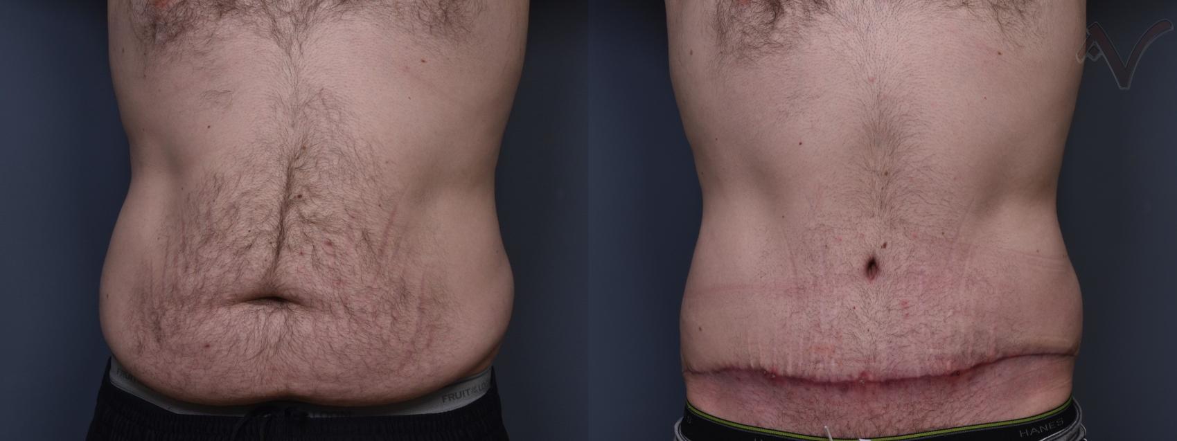 Before & After Abdominoplasty after Massive Weight Loss Case 411 Front View in Los Angeles, CA