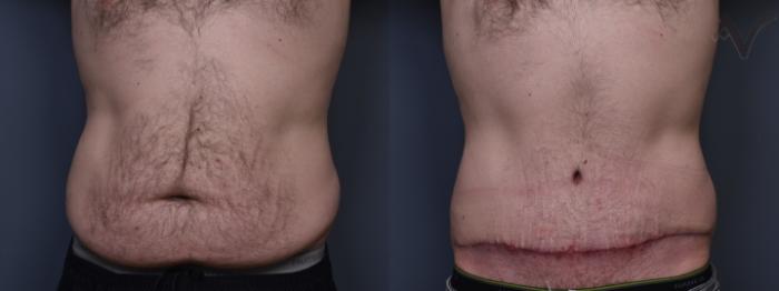 Before & After Abdominoplasty after Massive Weight Loss Case 411 Front View in Los Angeles, CA