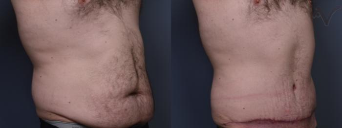 Before & After Abdominoplasty after Massive Weight Loss Case 411 Right Oblique View in Los Angeles, CA