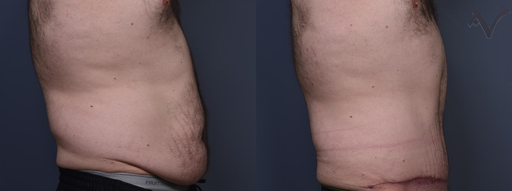 Before & After Abdominoplasty after Massive Weight Loss Case 411 Right Side View in Los Angeles, CA