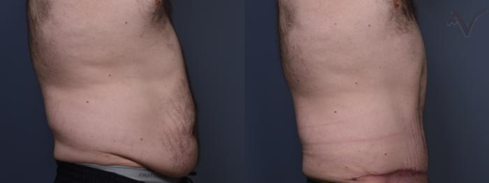 Before & After Abdominoplasty after Massive Weight Loss Case 411 Right Side View in Los Angeles, CA