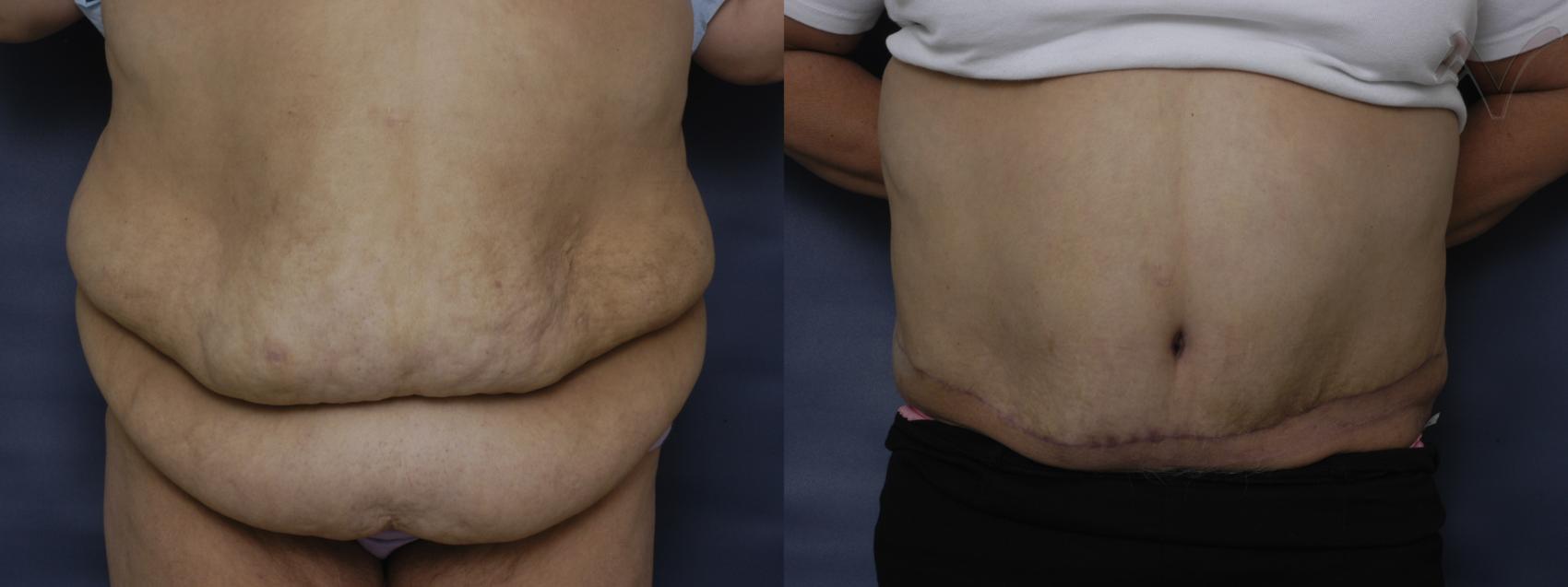 Before & After Abdominoplasty after Massive Weight Loss Case 57 Front View in Burbank, CA