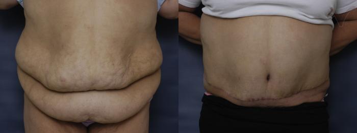 Before & After Abdominoplasty after Massive Weight Loss Case 57 Front View in Los Angeles, CA