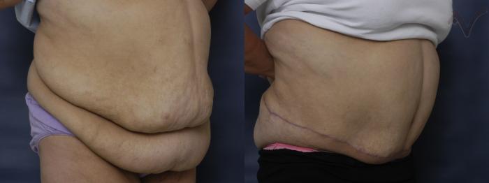 Before & After Abdominoplasty after Massive Weight Loss Case 57 Right Oblique View in Los Angeles, CA