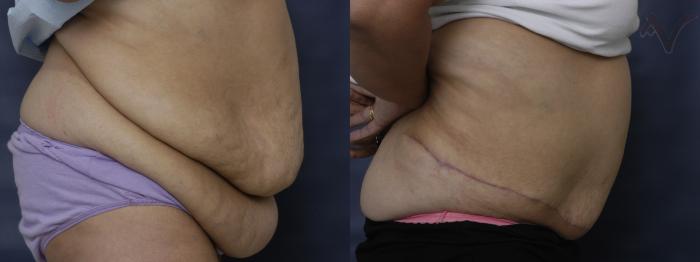 Before & After Abdominoplasty after Massive Weight Loss Case 57 Right Side View in Los Angeles, CA