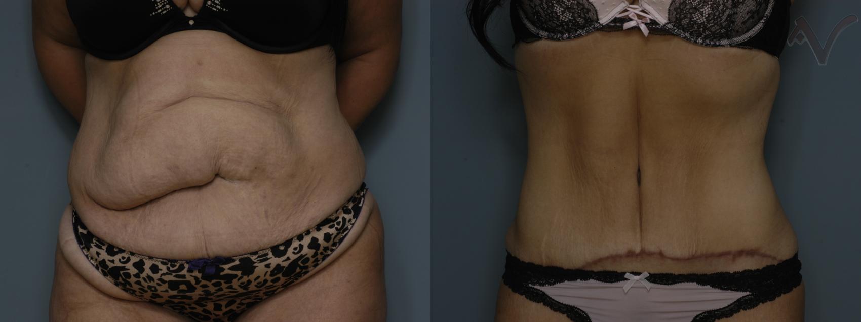 Before & After Abdominoplasty after Massive Weight Loss Case 58 Front View in Burbank, CA