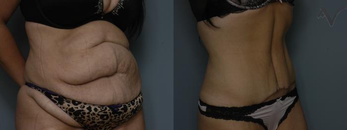 Before & After Abdominoplasty after Massive Weight Loss Case 58 Right Oblique View in Los Angeles, CA