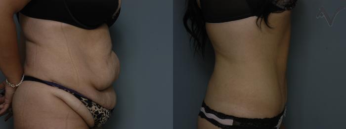 Before & After Abdominoplasty after Massive Weight Loss Case 58 Right Side View in Los Angeles, CA
