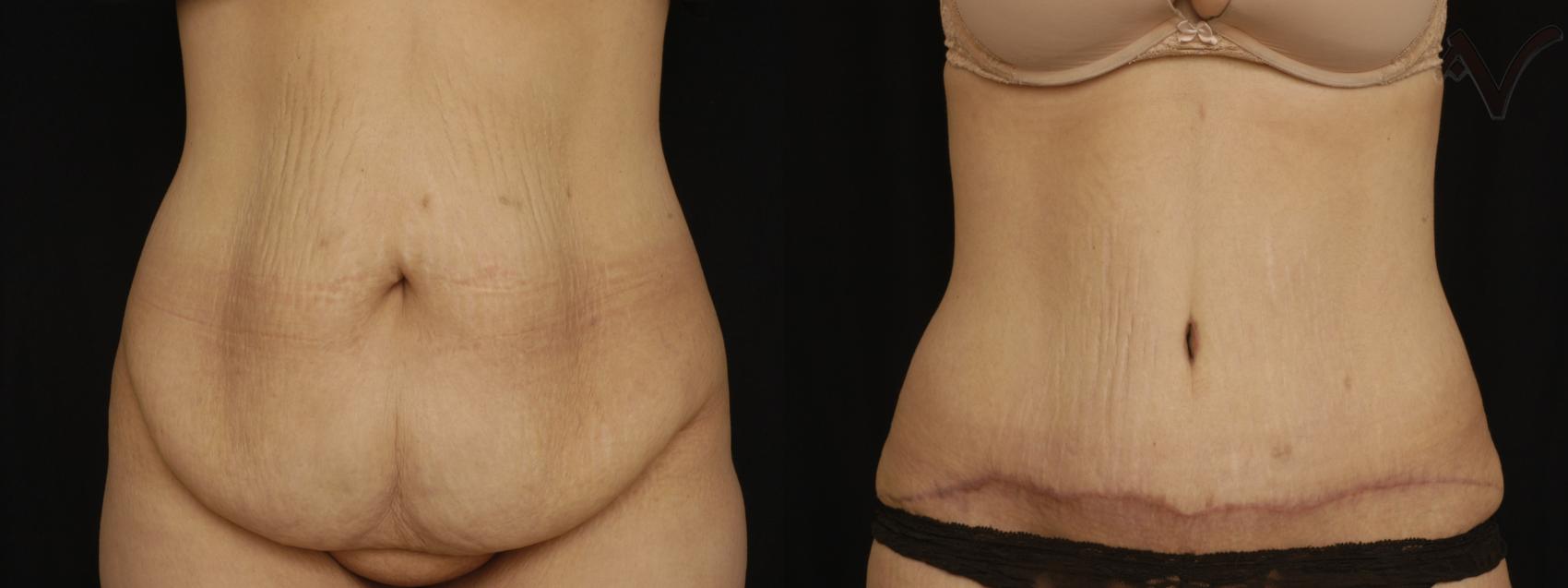 Before & After Abdominoplasty after Massive Weight Loss Case 59 Front View in Burbank, CA