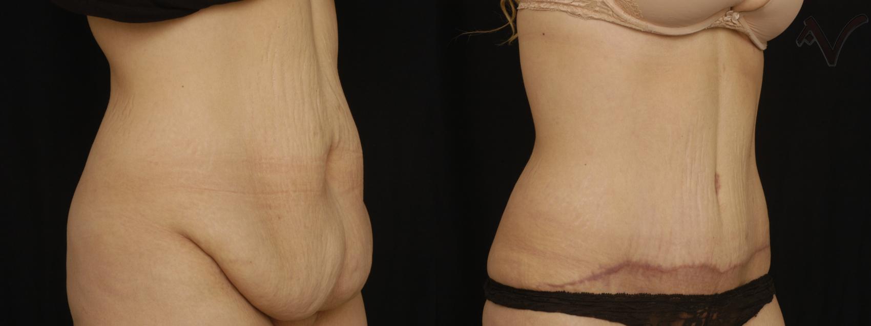 Before & After Abdominoplasty after Massive Weight Loss Case 59 Right Oblique View in Burbank, CA