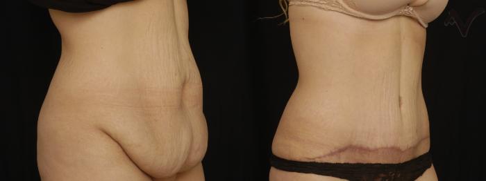 Before & After Abdominoplasty after Massive Weight Loss Case 59 Right Oblique View in Los Angeles, CA
