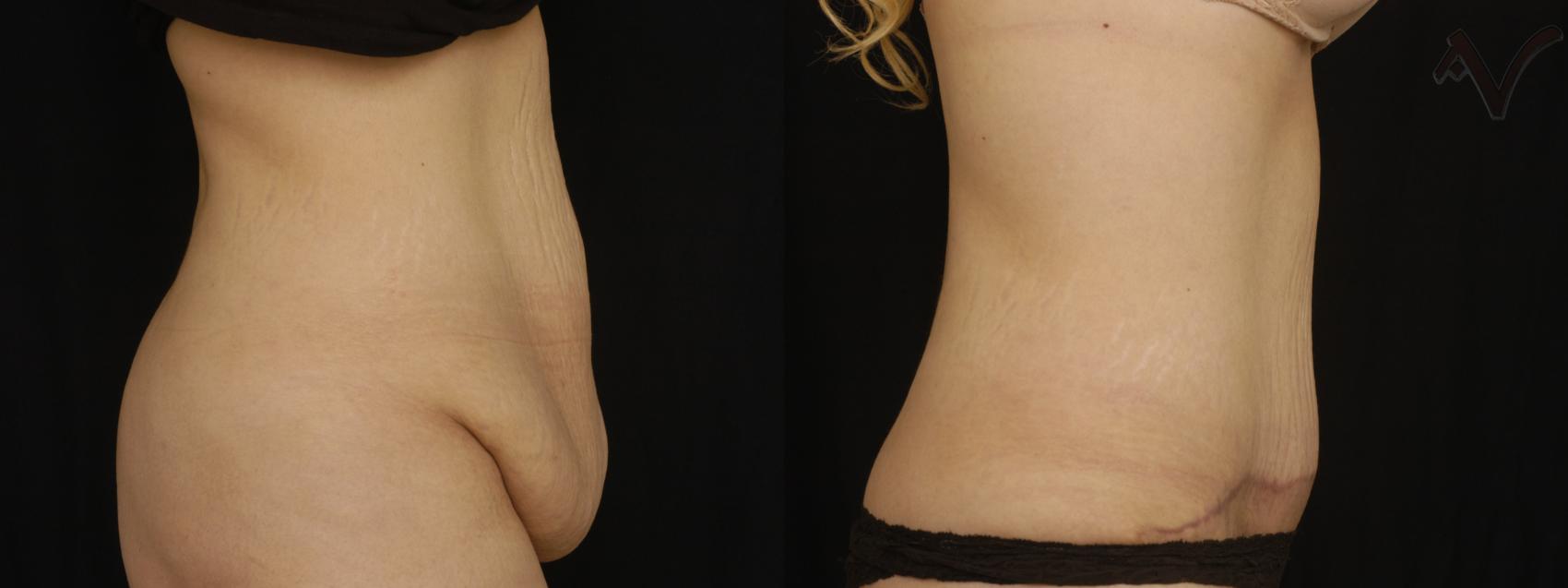 Before & After Abdominoplasty after Massive Weight Loss Case 59 Right Side View in Burbank, CA