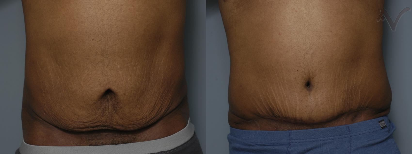 Before & After Abdominoplasty after Massive Weight Loss Case 60 Front View in Burbank, CA