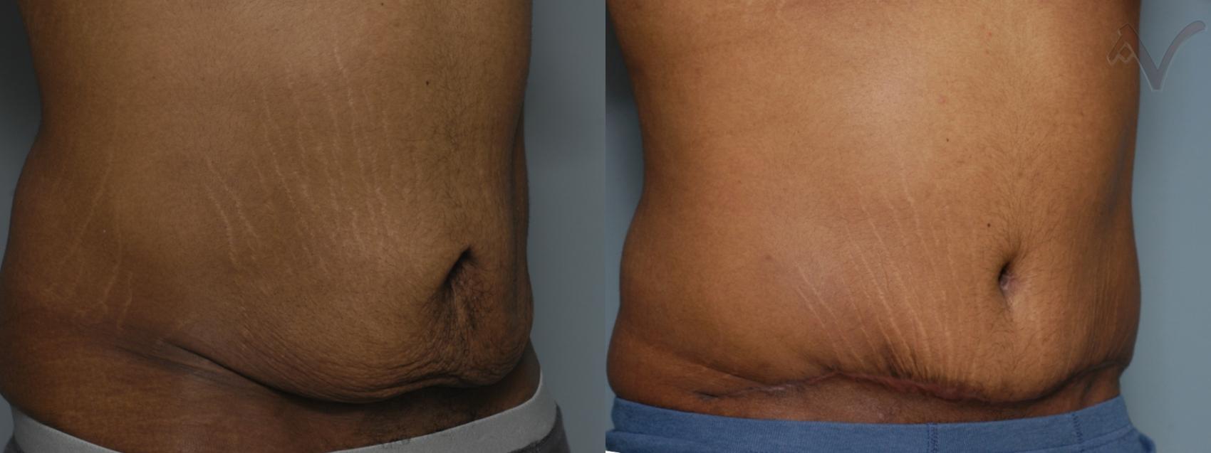 Before & After Abdominoplasty after Massive Weight Loss Case 60 Right Oblique View in Burbank, CA