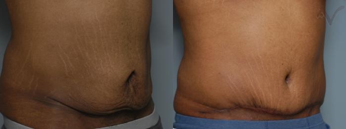 Before & After Abdominoplasty after Massive Weight Loss Case 60 Right Oblique View in Los Angeles, CA