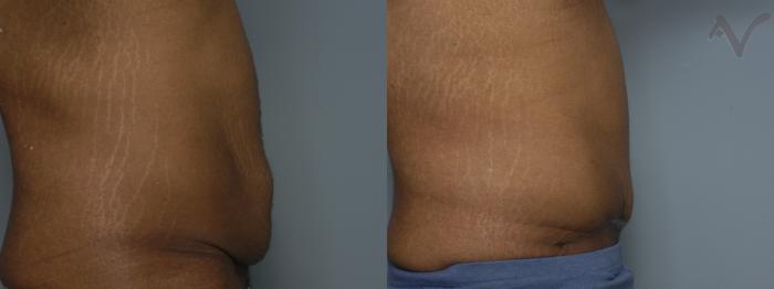 Before & After Abdominoplasty after Massive Weight Loss Case 60 Right Side View in Los Angeles, CA
