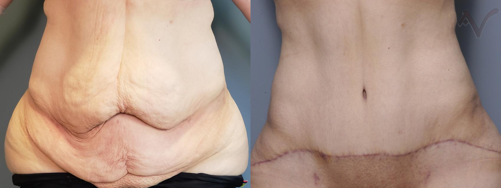 Before & After Abdominoplasty after Massive Weight Loss Case 70 Front View in Los Angeles, CA