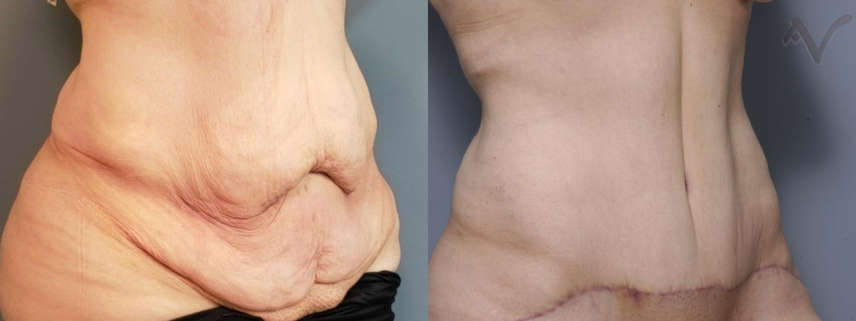 Before & After Abdominoplasty after Massive Weight Loss Case 70 Right Oblique View in Burbank, CA