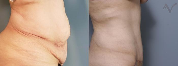Before & After Abdominoplasty after Massive Weight Loss Case 70 Right Side View in Los Angeles, CA