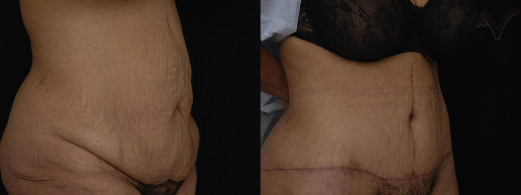 Before & After Abdominoplasty after Massive Weight Loss Case 71 Right Oblique View in Burbank, CA