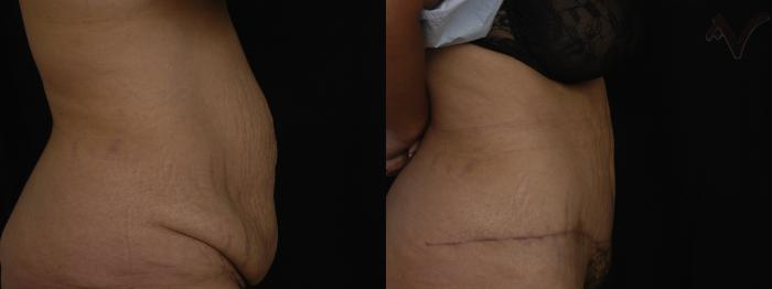 Before & After Abdominoplasty after Massive Weight Loss Case 71 Right Side View in Los Angeles, CA