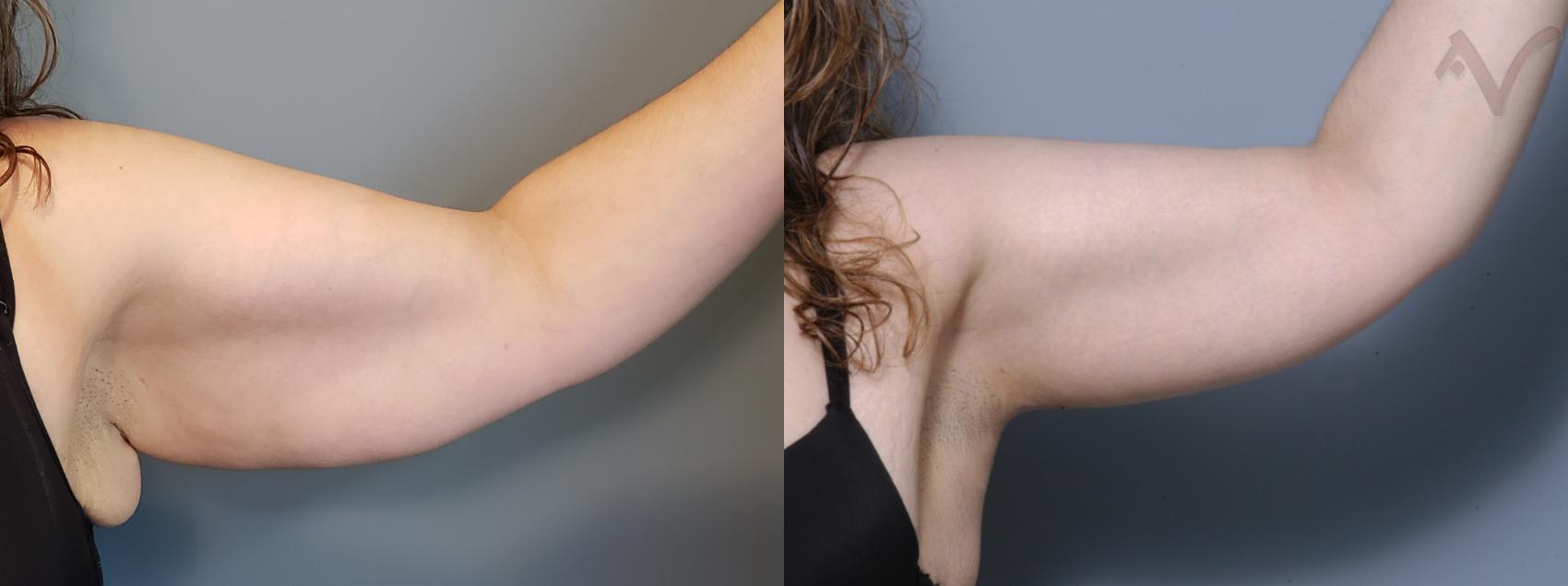 Before & After Arm Lift Case 16 Left Side View in Burbank, CA