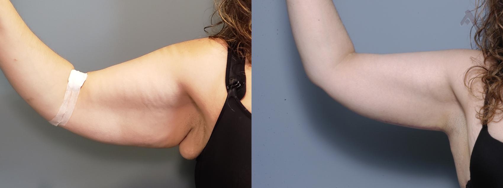Before & After Arm Lift Case 16 Right Side View in Los Angeles, CA