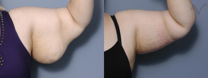 Before & After Arm Lift Case 17 Left Side View in Los Angeles, CA