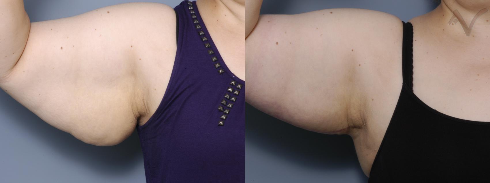 Before & After Arm Lift Case 17 Right Side View in Los Angeles, CA