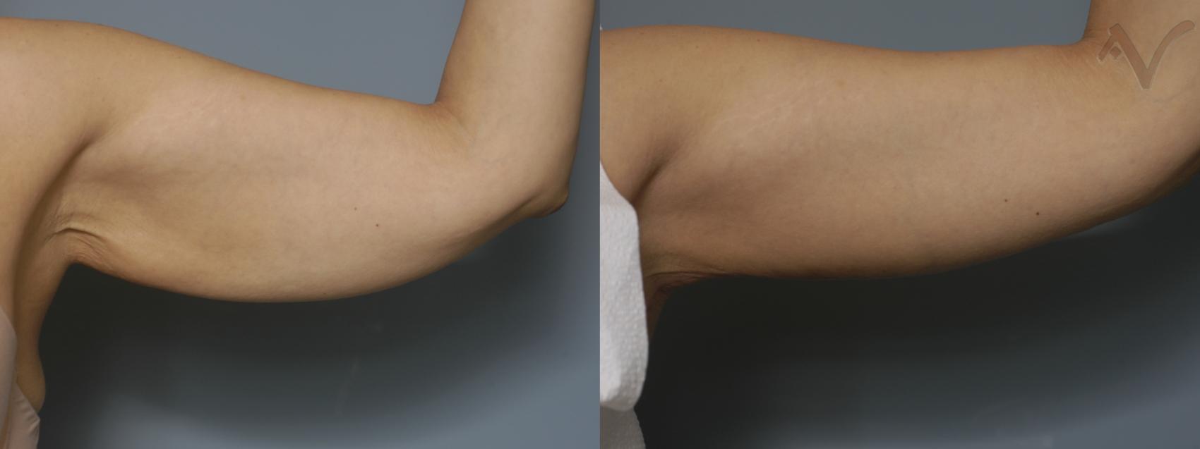 Before & After Arm Lift Case 18 Left Side View in Burbank, CA