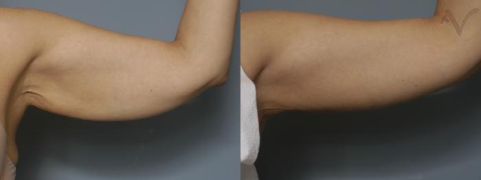 Before & After Arm Lift Case 18 Left Side View in Los Angeles, CA